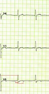 Estimulación acelerada atrio-ventricular