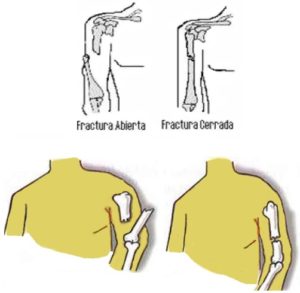 Fracturas abier y cerradas