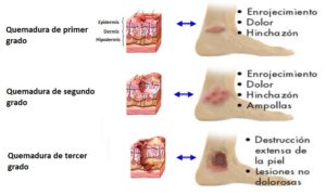 Tipos de quemaduras